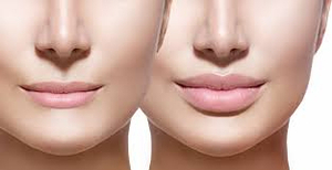 Perfect Your Smile – Lip Filler at VRAI