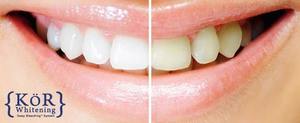 Kor whitening before and after s300