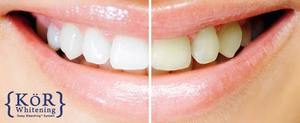 Professional Teeth Whitening