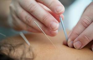 Acupuncture Treatment with Abbey Timms